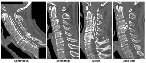 Jcm Free Full Text Association Of Inflammation Ectopic Bone