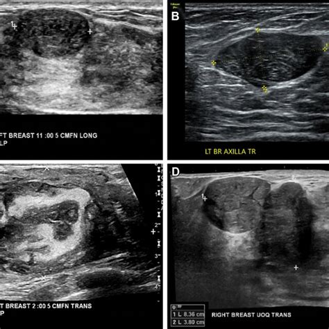 Phyllodes Tumors May Display A Range Of Ultrasound Appearances And