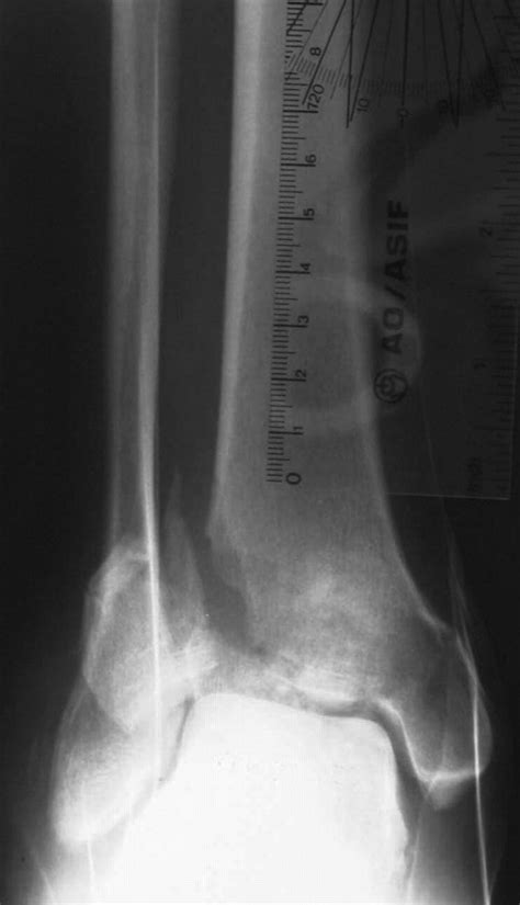 Anatomy Of Pilon Fractures Of The Distal Tibia Bone And Joint