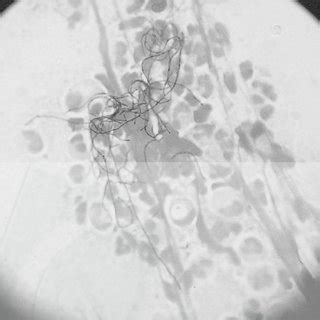 Gram stain of bronchoalveolar lavage fluid showing typical ...