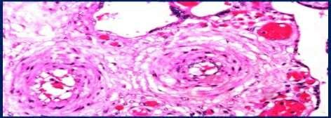 Endarteritis obliterans-Vessels showing narrowing of lumen... | Download Scientific Diagram