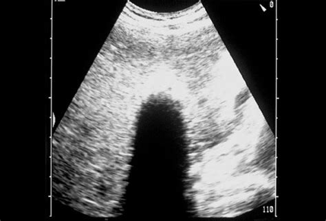 Bedside Ultrasonography Gallbladder Evaluation Slideshow