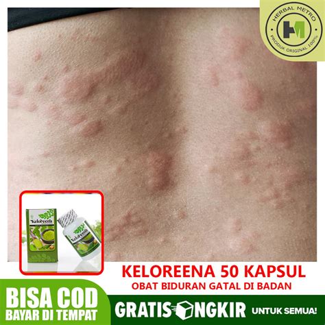 Jual Obat Biduran Gatal Gatal Bentol Di Badan Kaligata Alergi Dingin