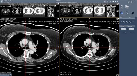 Neuroendocrine Tumors: Where Diagnosis and Treatment Meet