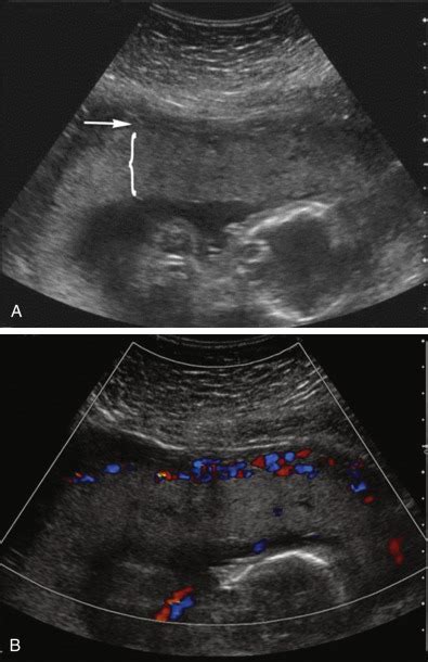 Ultrasound Evaluation Of The Placenta Membranes And Umbilical Cord