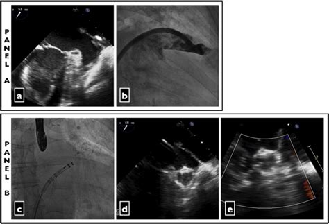 A New Approach Left Atrial Appendage Occlusion As An Alternative To Anticoagulant To Treat