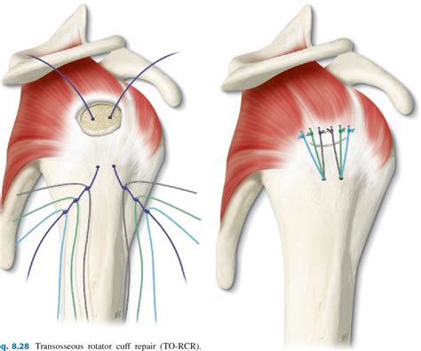 Arthroscopic Transosseous Rotator Cuff Repair Semantic Scholar