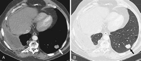 Pleural Tumors Radiology Key