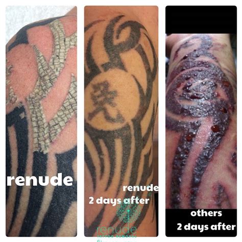 Pin on tattoo removal advertising