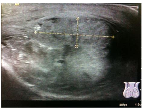 Testicular Rupture Ultrasound