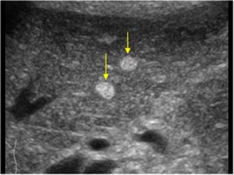 Hyperechoic Ultrasound