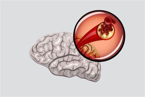 Isquemia Cerebral O Que Sintomas E Tratamento Tua Sa De