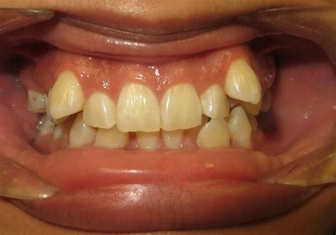 Before And After Orthodontic Course Cases Orthodontic Teaching Institute