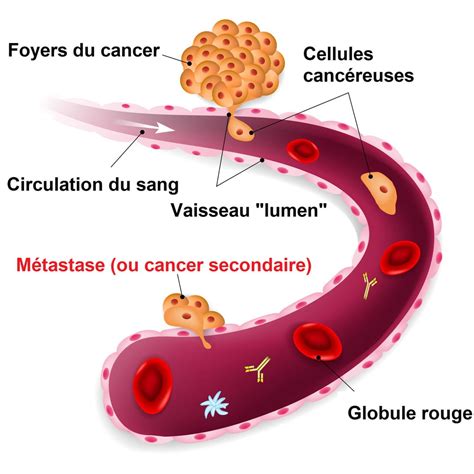 Cancer Secondaire Sympt Mes Traitement Quelle Esp Rance De Vie