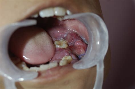 Young Male With Rapidly Swelling Jaw - Annals of Emergency Medicine