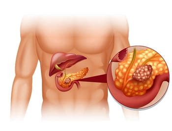 Cáncer de páncreas síntomas y causas CCM Salud