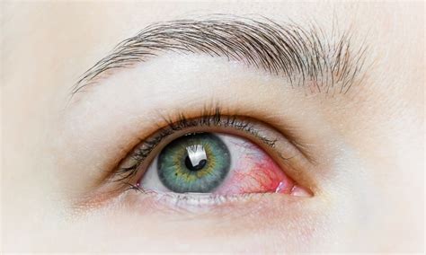 Conjunctivitis Pink Eye Causes Symptoms Treatment Pure Optical