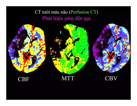 Ct Chấn Thương Sọ Não Ppt