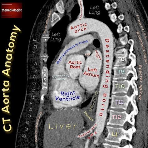 Check out this sagittal view of a CT aorta...⁣ ⁣ TAKE NOTE OF:⁣ ⁣ 📝We ...