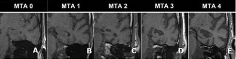 Axial FLAIR images show different degrees of medial temporal lobe ...