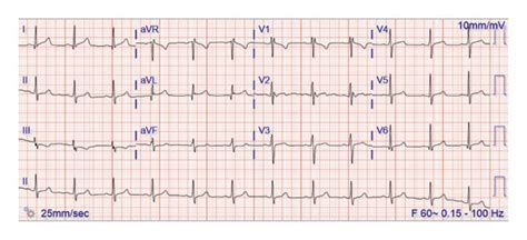 The Patients EKG On Admission Which Demonstrates Sinus Rhythm With