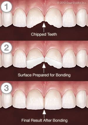 Cosmetic Resin Bonding | Advanced Dentistry | San Francisco CA