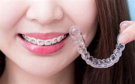 How Much Do Braces Cost Cosmetique Dental