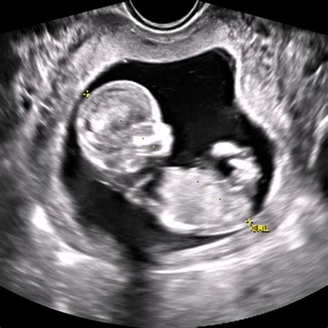 Pregnancy Ultrasound Training Second and Third Trimester