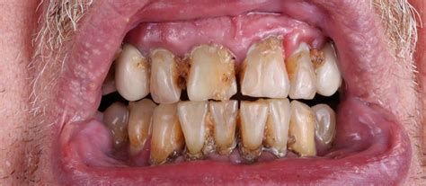 Oral Malignant Melanoma Gums