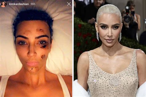 Kim Kardashian Opened Up About Her Psoriasis Flare-Up That Nearly ...