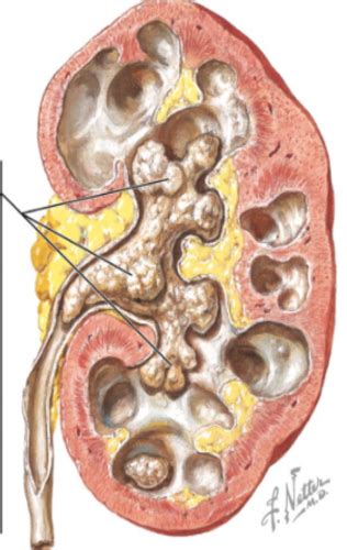 Ch Alteration Of Renal And Urinary Tract Function Dr Stem