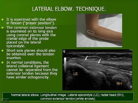 Figure From Ultrasound Of The Elbow What The Radiologist Should Know