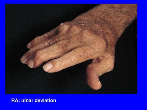 Ppt Rheumatoid Arthritis Ra Powerpoint Presentation Free Download Id 1740166