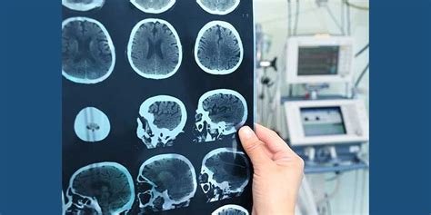 Aneurisma Cerebral Qué es Tipos síntomas causas secuelas y mas