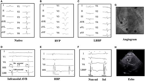 Frontiers Feasibility And Outcomes Of Upgrading To Left Bundle Branch Pacing In Patients With