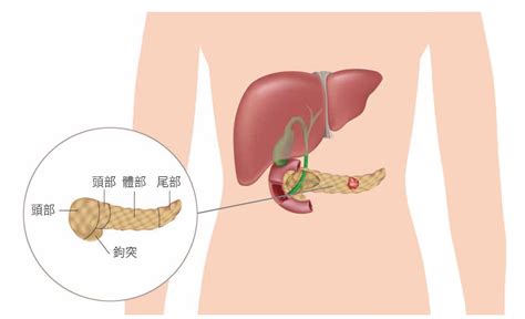 診斷奪命癌王胰臟癌－高階影像檢查的重要性 永越健康管理中心