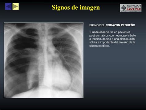 PPT Taponamiento cardíaco Causas y hallazgos radiológicos PowerPoint