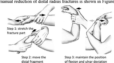 Design of fracture reduction device for distal radius | Semantic Scholar