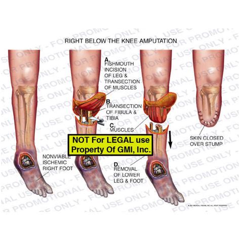 Right Below The Knee Amputation B Generic Medical Legal Exhibits