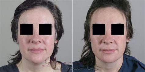 Facelift Before And After Pictures Case 22 Paramus Nj Parker Center For Plastic Surgery