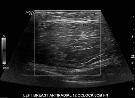 Breast Lipoma Radiology Case