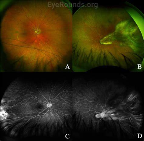 Eyerounds Org Familial Exudative Vitreoretinopathy Fevr