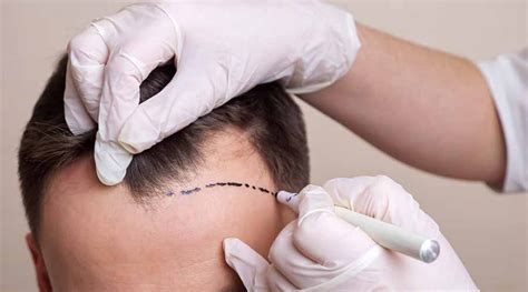 Different Hair Transplantation Techniques A Guide For Men And Women