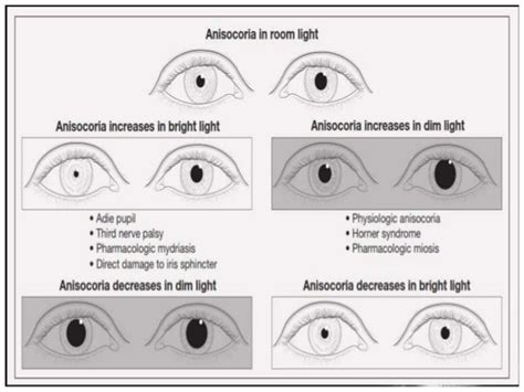 Anisocoria