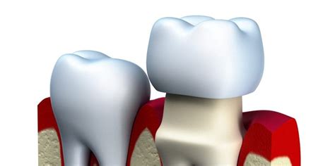 What Are Dental Crowns Made Of Greensboro NC Dentist