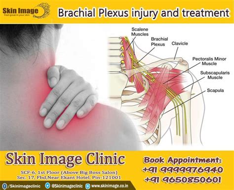 Brachial plexus injury treatment – Artofit