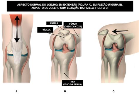 Instabilidade Patelar Ortopedia Galv O