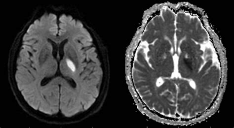 Mri Of A New Infarction In Basal Ganglia Regions Download Scientific Diagram