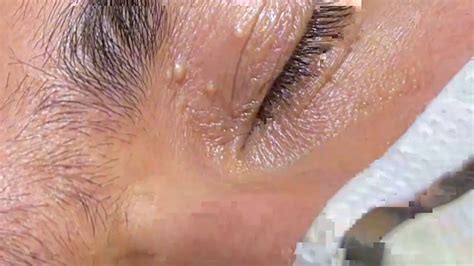 Eyelid Extractions Milia Extractions Pearly Eyelid Pops Many Small