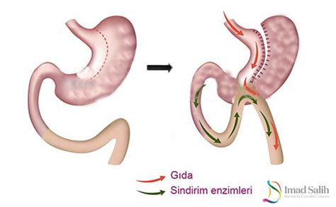 Metabolik Cerrahi Nedir Opr Dr Mad Salih Kasapo Lu